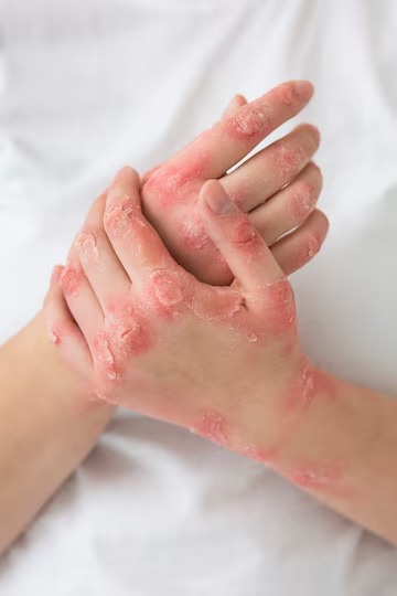 Mpox Clade 1 Strain in America, Mpox, Clade 1, Mpox Clade 1, Monkey Pox, Symptoms of Mpox, Prevention of Mpox,