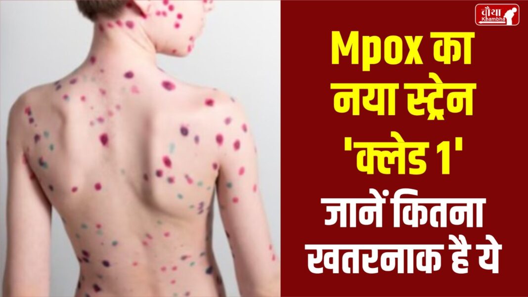 Mpox Clade 1 Strain in America, Mpox, Clade 1, Mpox Clade 1, Monkey Pox, Symptoms of Mpox, Prevention of Mpox,