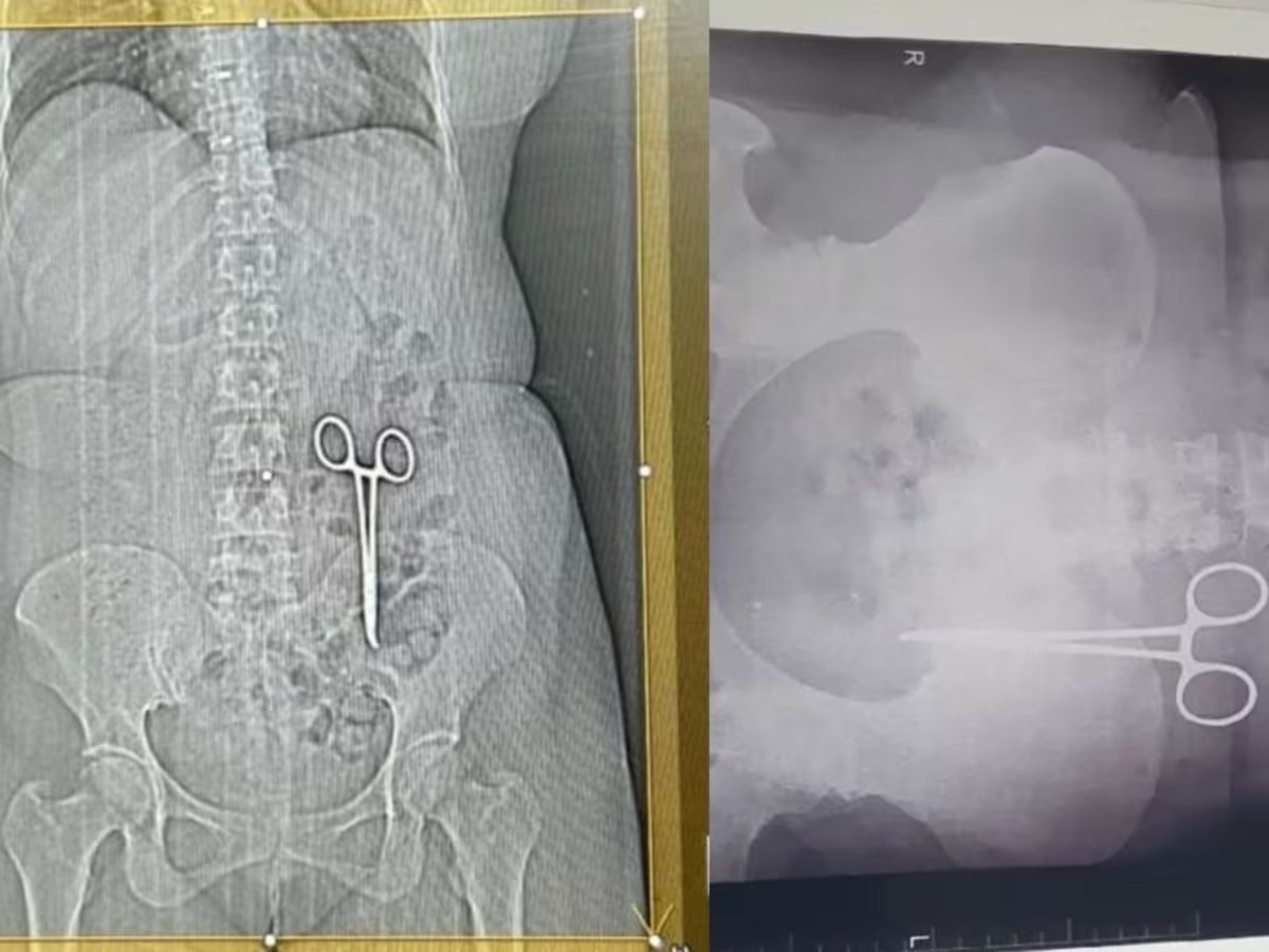 Scissors Found In Stomach