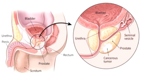 Joe Biden cancer, Former US President, Joe Biden, Former US President cancer, prostate cancer diagnosis,