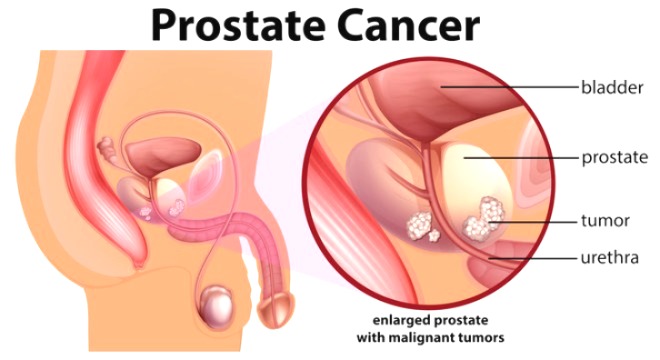 Joe Biden cancer, Former US President, Joe Biden, Former US President cancer, prostate cancer diagnosis,